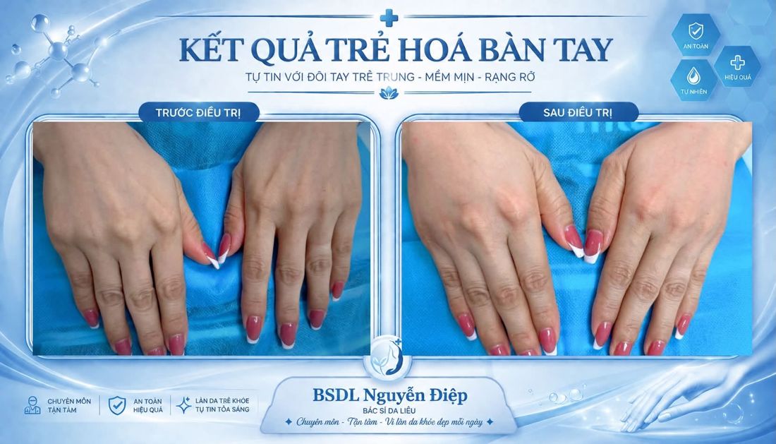 Kết quả trẻ hóa bàn tay