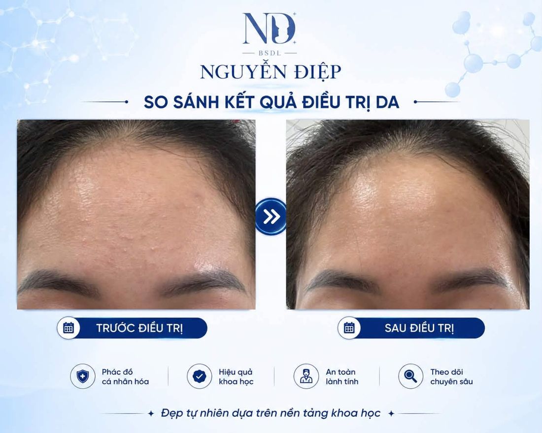 So sánh trước và sau điều trị da vùng trán