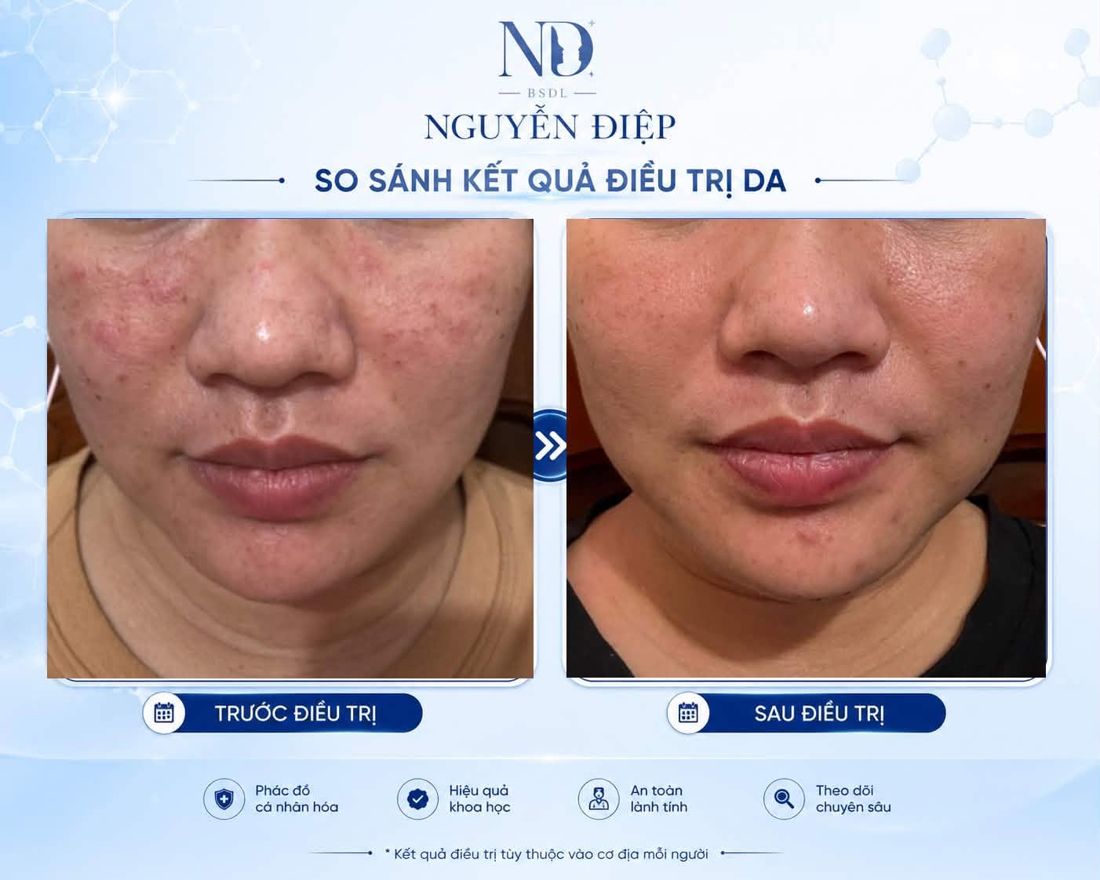 So sánh trước và sau điều trị da mặt