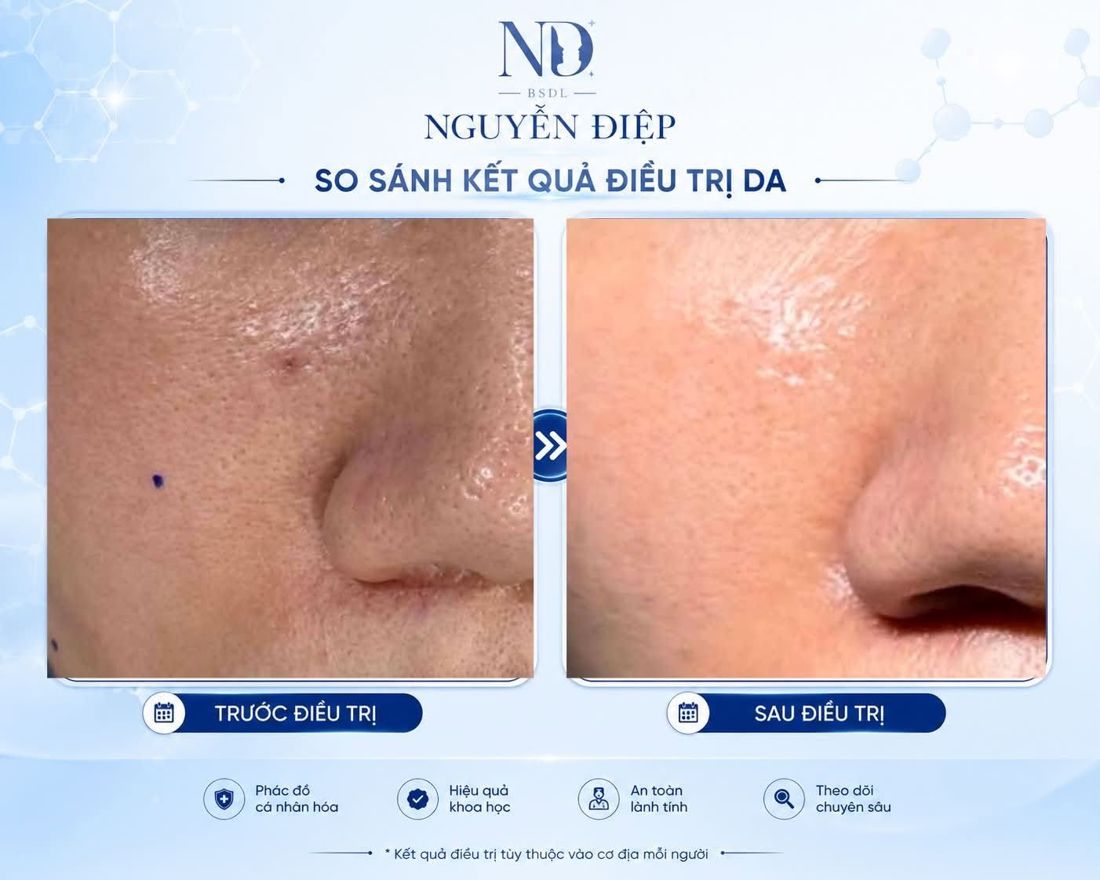 So sánh trước và sau điều trị da vùng mũi
