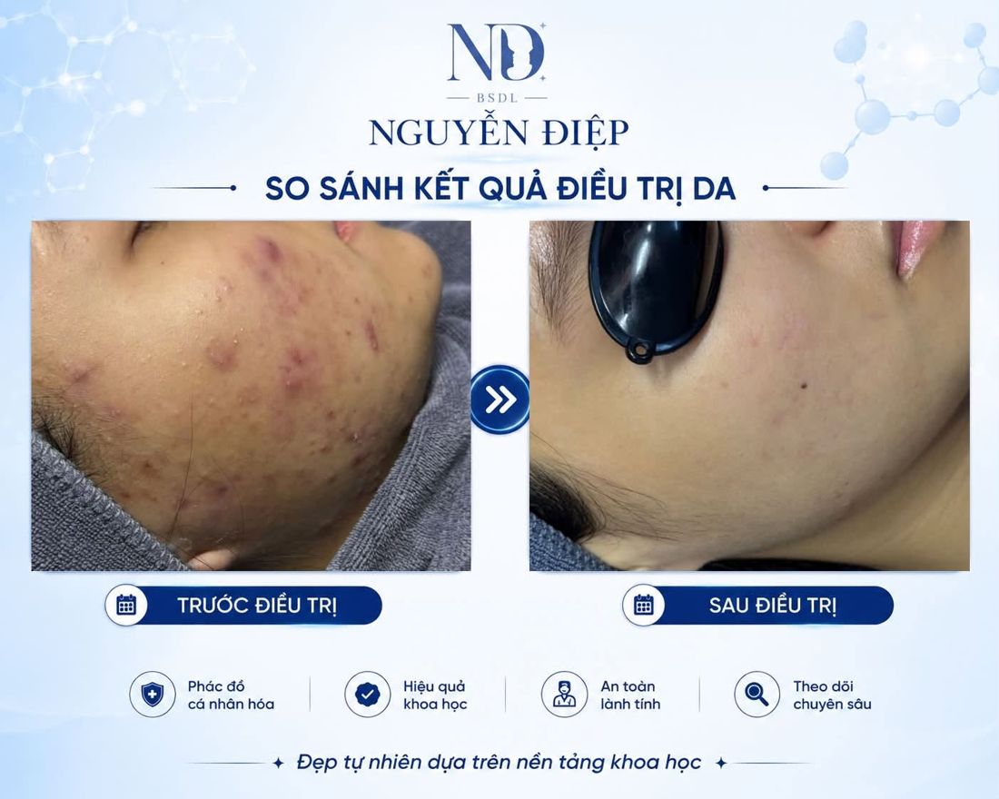 So sánh trước và sau điều trị mụn